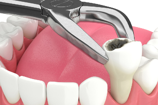 Post-Extraction Care