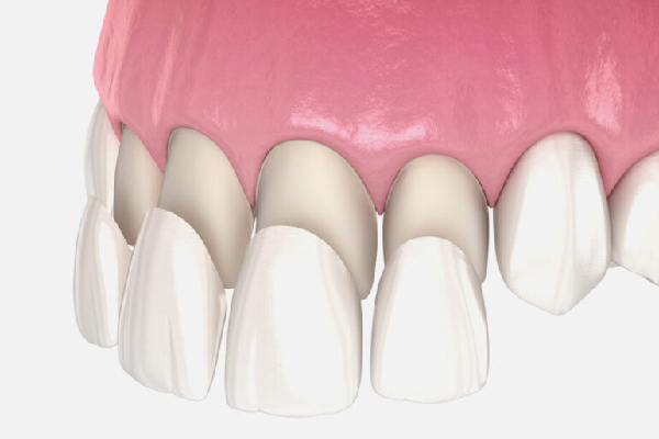 Final Veneer Placement